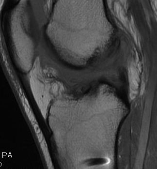 Ruptured ACL Graft MRI T1